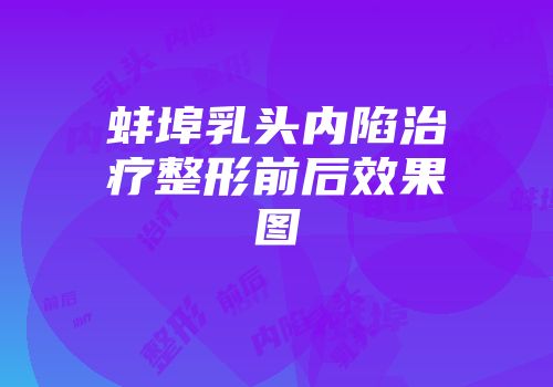 蚌埠乳头内陷治疗整形前后效果图